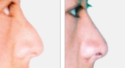 鼻头缩小手术后护理_鼻头缩小手术后八个月能变小吗