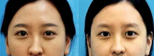 软骨隆鼻：有效提升面部美感的方法