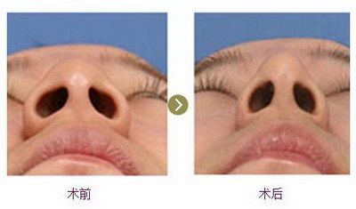 扁鼻孔和圆鼻孔