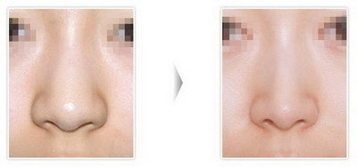 鼻子玻尿酸多久能溶解(什么是鼻子玻尿酸？)