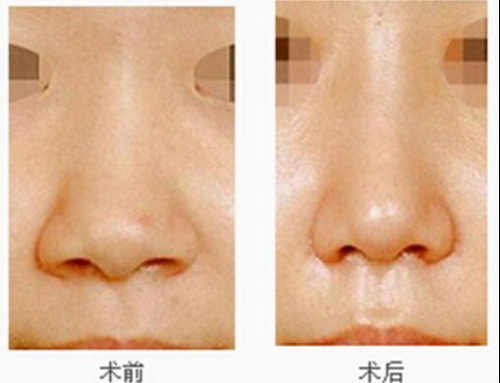 鼻综合手术的持久性：有效的改善和保持效果