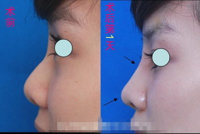 做完硅胶隆鼻注意什么(做硅胶假体隆鼻术前需要注意什么)