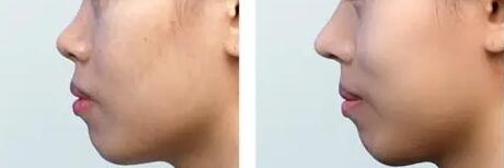 硅胶隆鼻的危害会(硅胶隆鼻术后的危害)