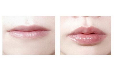 唇炎导致左右唇红缘不对称
