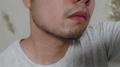 无痕种植胡子怎么样呢？