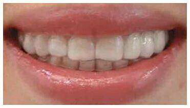 镶牙和种植牙有什么不同(镶牙和种植牙有什么区别嘛)