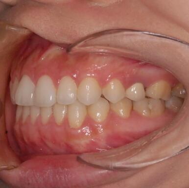 牙槽骨吸收多久形成