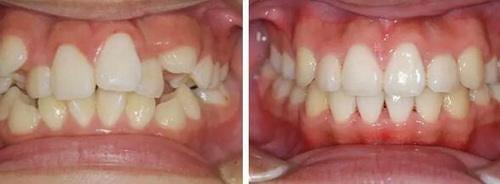 牙龈化脓牙齿松动