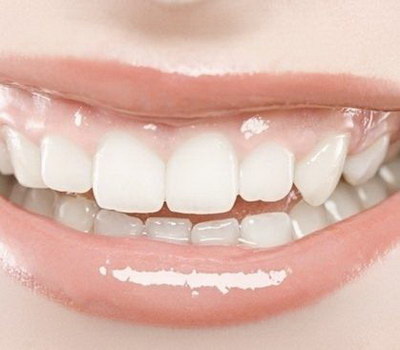 牙龈大怎么办矫正(牙齿正在矫正,可牙龈却沿着牙缝生长,怎么办)