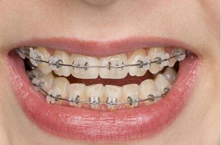 牙龈萎缩严重还能种植牙吗