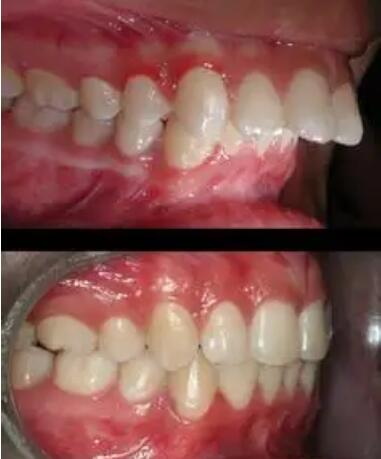 牙龈炎牙周炎的治疗方法