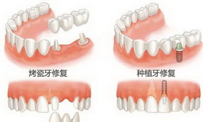 修复性牙本质是什么【修复性牙本质作用大吗】