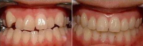 牙齿种植的手术多久？