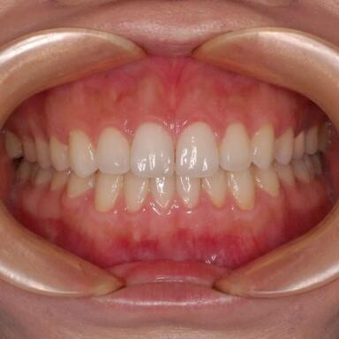 牙齿整形和矫正有几种方法
