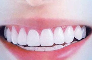 牙髓感染的途径【牙髓感染的主要途径是】