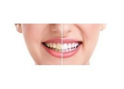 牙齿美白方法是什么
