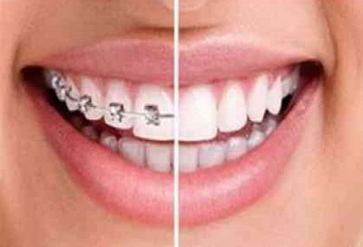 种牙会导致牙龈萎缩吗(牙龈萎缩导致牙齿松动可以种牙么)