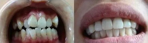 隐形牙套多久牙齿开始移动(隐形牙套的矫正多久能排齐牙齿)