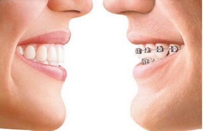 拔牙矫正会导致牙齿松动吗