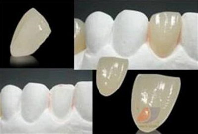 牙髓炎根管治疗需多长时间(根管治疗的过程)