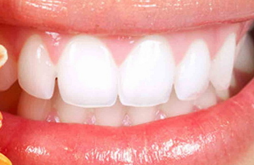正畸托槽位置(正畸牙粘托槽位置靠近牙龈)
