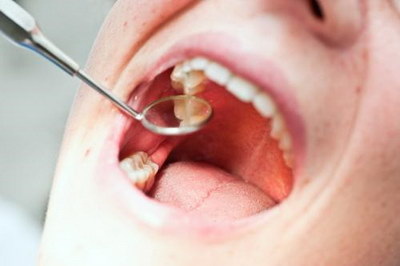 牙齿肿痛牙齿松动需要拔牙吗(牙齿松动牙龈肿痛是怎么回事)