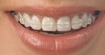 大牙有黑色的缝隙是什么