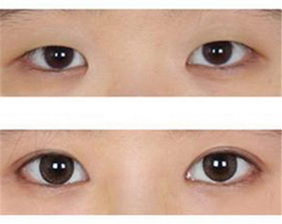 开内眼角手术有哪些缺点「开内眼角手术的护理措施有哪些」