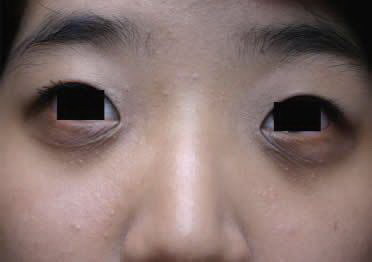 双眼皮手术对人有什么坏处