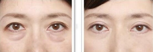 男生割双眼皮前后对比照片(男生割双眼皮一年后前后对比)