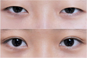 对于双眼皮手术要做什么样的术后护理？