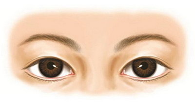 埋线双眼皮是永久双眼皮手术吗(双眼皮埋线手术是永久的吗)