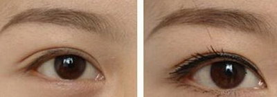 韩式三点双眼皮的恢复时间是多久_韩式三点双眼皮恢复时间