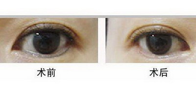 什么是魅力双眼皮手术呢