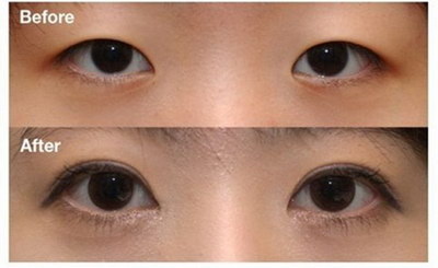 做双眼皮有多少种方法呢？