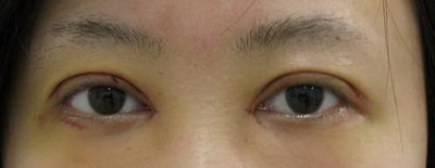 提肌无力可以用过双眼皮手术解决(眼肌型肌无力可以做双眼皮手术吗)