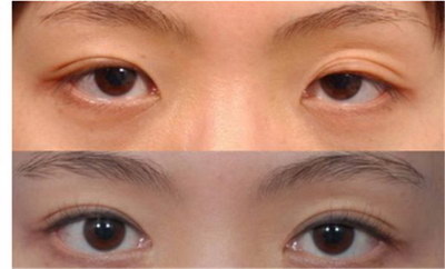 韩式双眼皮手术恢复期