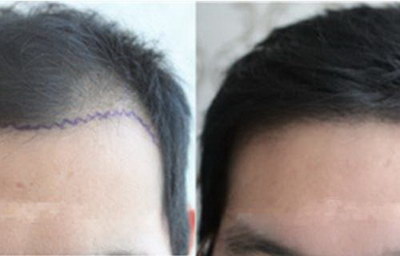头发损伤修复的方法与技巧