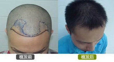 自体毛发移植技术(自体毛发移植专家)