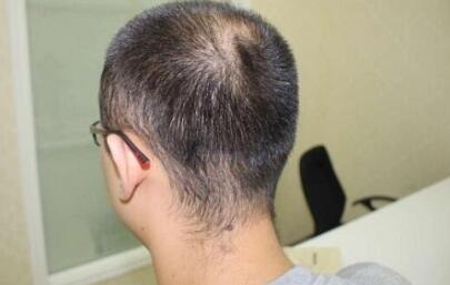 植发后多久可以做头发烫染？