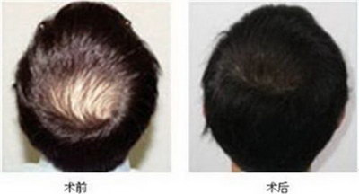 武汉植发：一种改善头发稀疏的完美方案