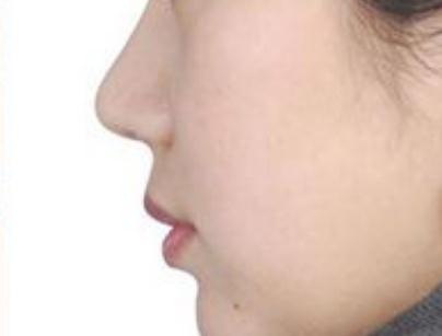 简述现在的几种鼻尖美容术