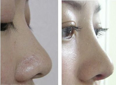 假体跟膨体隆鼻的区别「膨体隆鼻和假体的区别」