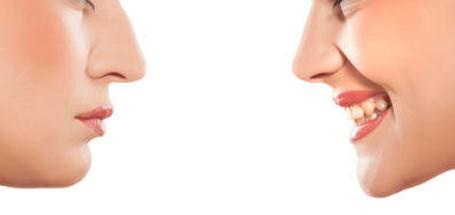 什么是鼻综合假体下滑？(鼻综合假体外露什么样子)
