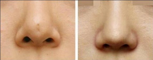 鼻子整容鼻综合(鼻综合整形：让您的鼻子变得更美丽自信)
