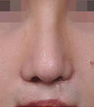 隆鼻手术后肿眼泡多久消除