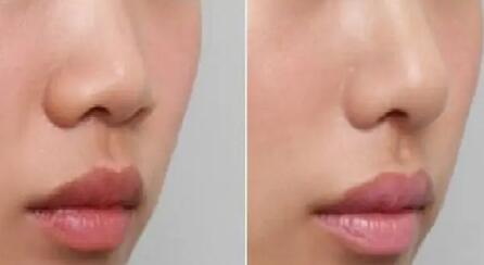 隆鼻的最好方法是哪种？