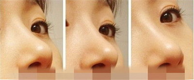 缩鼻翼鼻头方法(缩鼻翼鼻头几种方法)