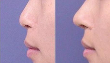 鼻子上毛孔洞怎么修复「鼻子上有个大的毛孔洞」