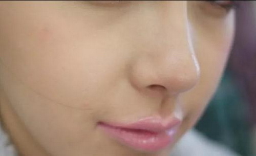 韩国鼻子整形整容手术
